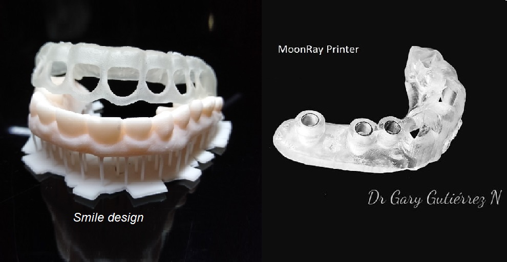 Smile design và làm máng inplant 3D